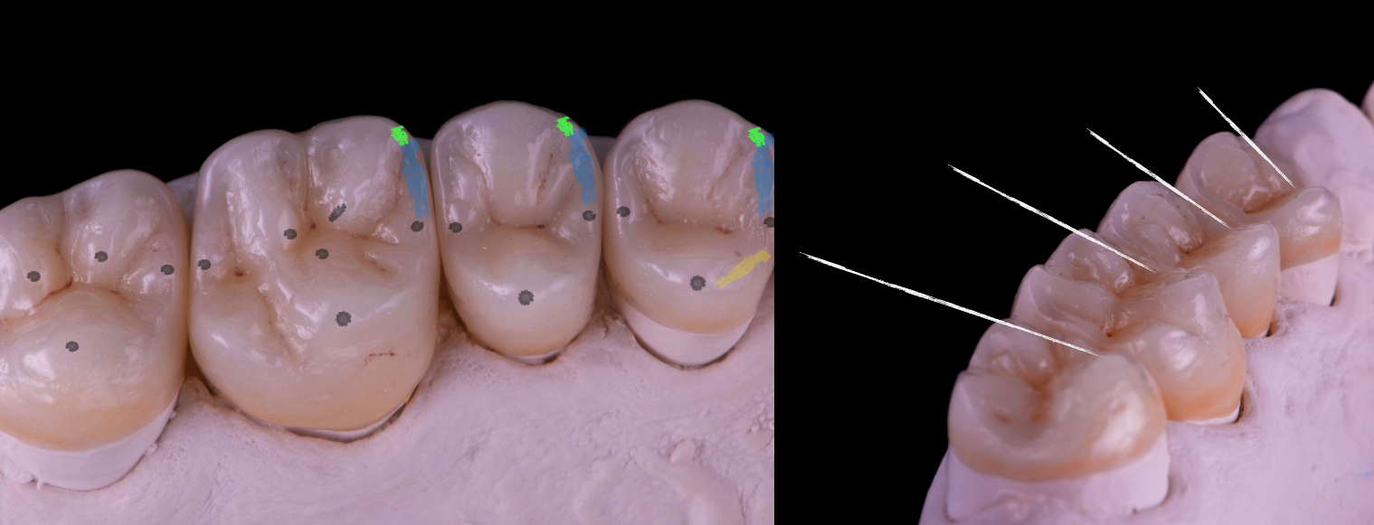 Sequential occlusion: functional morphology on posterior restorations
